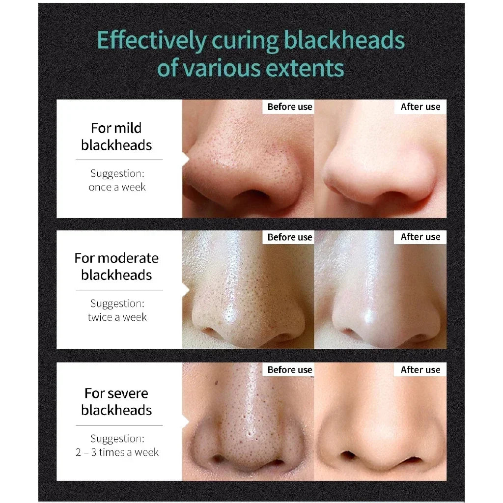 LANBENA Blackhead Maske – Tiefenreinigung & Porenpflege